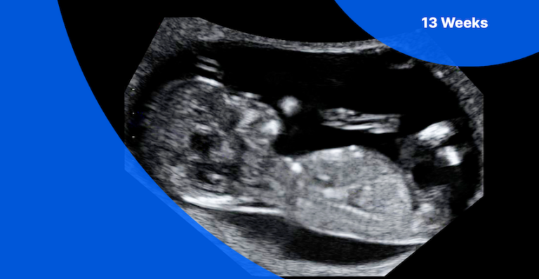 13 Week Gestation Ultrasound: A Comprehensive Overview