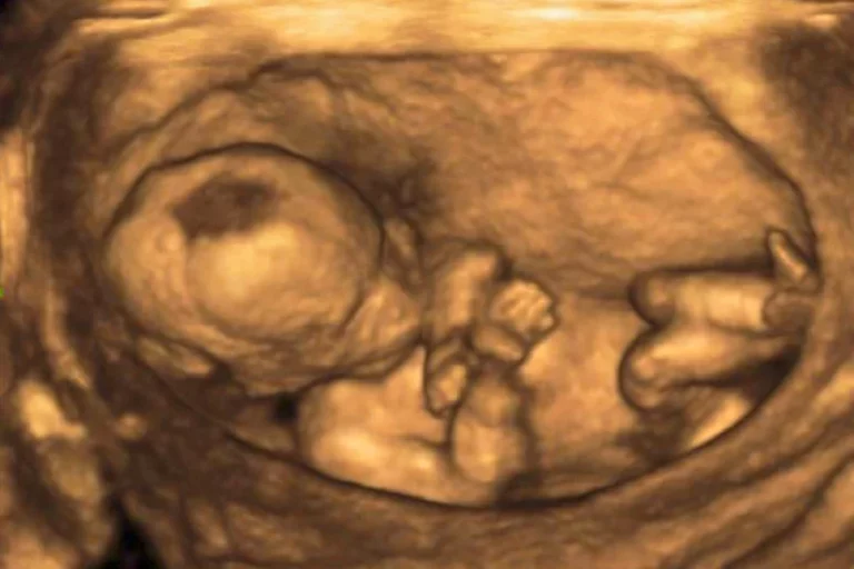 14 Week Ultrasound: A Comprehensive Guide for Expecting Parents