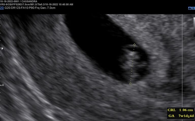 3D Ultrasound at 7 Weeks Pregnant: A Detailed Look into Your Baby’s Development