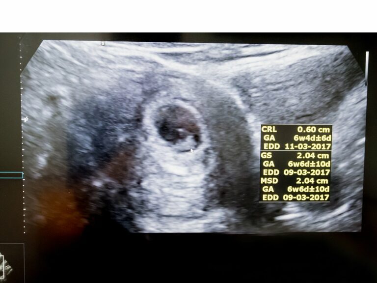 6 Weeks Pregnant Ultrasound Pictures: A Comprehensive Guide