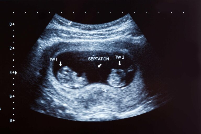 6 Weeks Pregnant Ultrasound Twins: A Comprehensive Guide