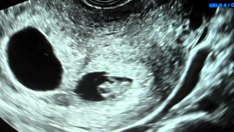 8 Week Twin Ultrasound: A Comprehensive Guide to Your Early Pregnancy Journey