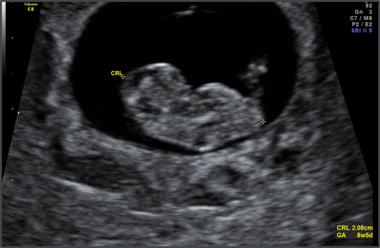 8 Weeks Pregnant Sonogram Pictures: A Comprehensive Guide to Fetal Development and Assessment