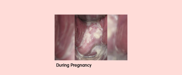 Cervix Early Pregnancy Photos: A Comprehensive Guide to Visual Assessment