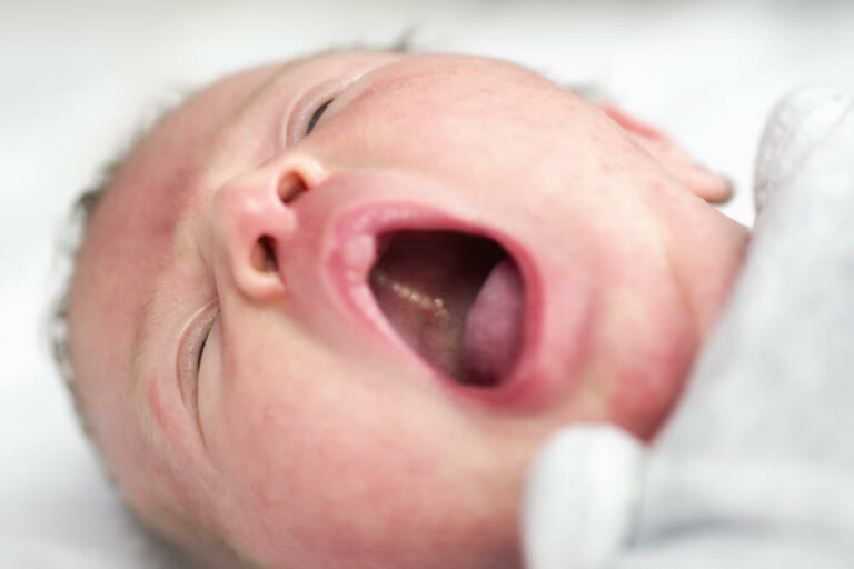 Epstein Pearls In Infants: A Comprehensive Guide for Parents