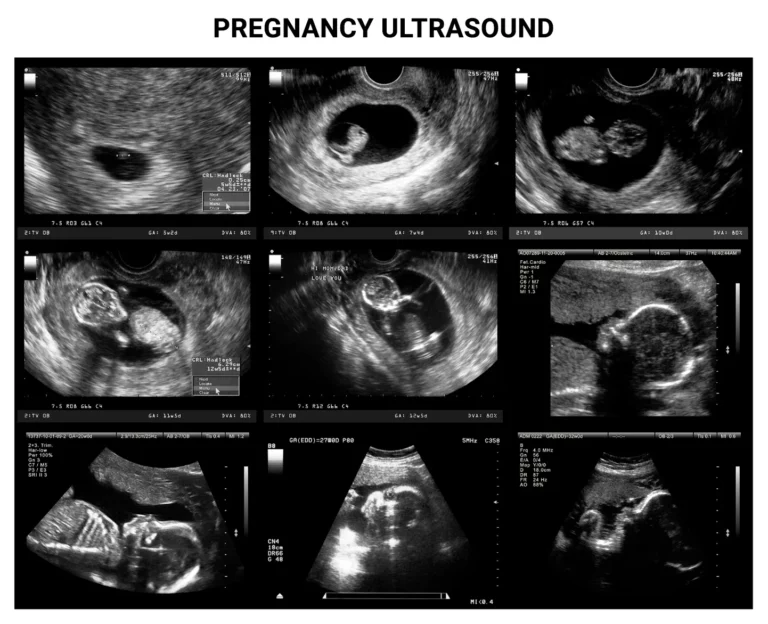 How Many Ultrasounds During Pregnancy: A Comprehensive Guide