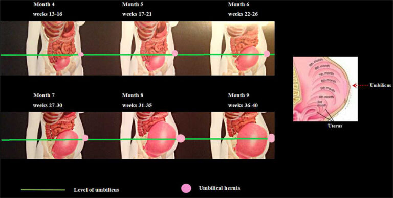 Navel Hernia During Pregnancy: Understanding, Diagnosis, and Management