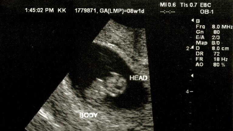 Sonogram At 8 Weeks: A Comprehensive Guide For Expectant Parents