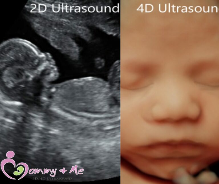 Unveiling Pregnancy’s Early Journey: A 6 Weeks Ultrasound Picture