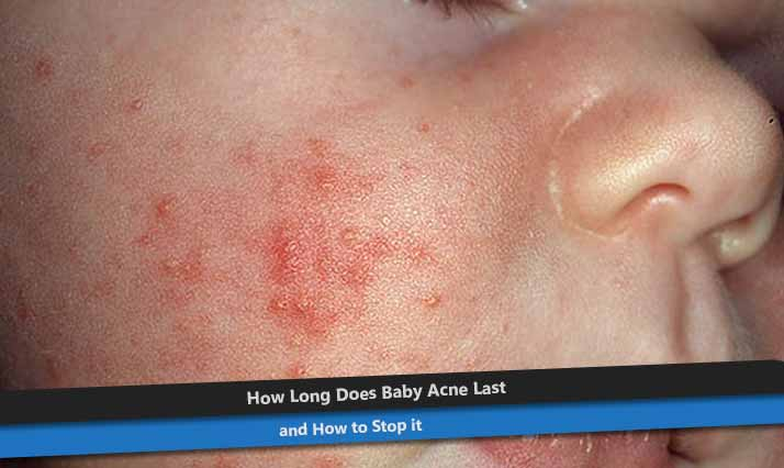 Baby Acne Causes And Signs Symptoms And Treatment Methods Acne In Baby