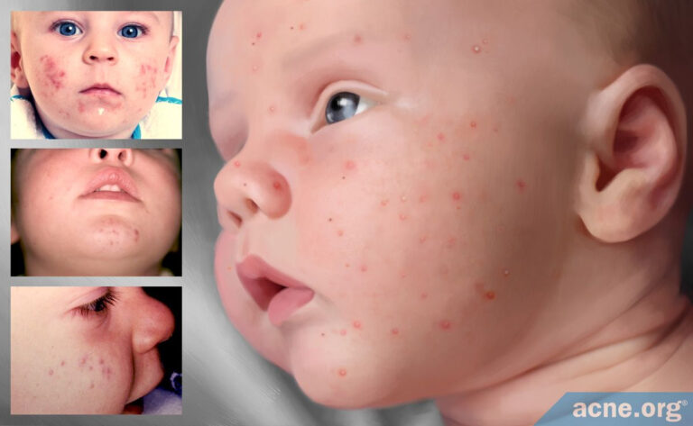 Baby Acne What Is It And What Causes It Acne