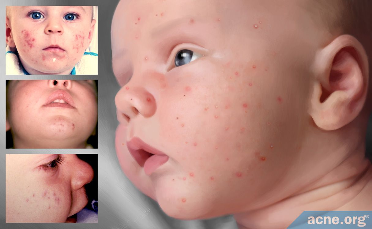 Baby Acne What Is It And What Causes It Acne