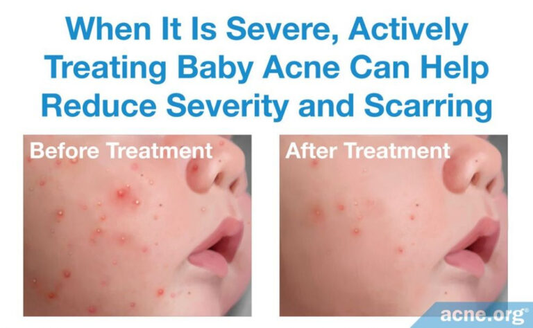 Baby Acne What Is It And What Causes It Acne