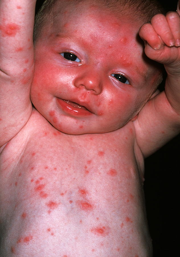 Baby Boy With Chickenpox Photograph By Dr P Marazzi science Photo Library