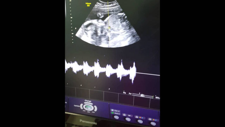 Baby Heart Beat In Womb At Nicholas Petterson Blog