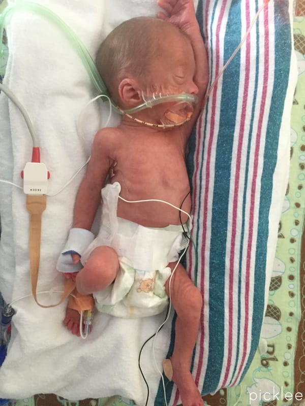 Born At 28 Weeks Our Twin Birth Story Picklee
