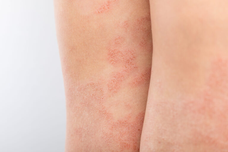 Eczema In Babies And Children London Paediatrician