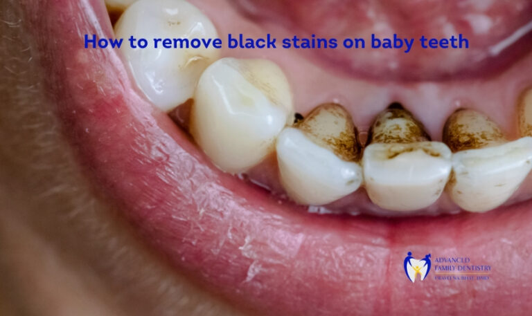 Effective Ways To Remove Black Stains On Baby Teeth