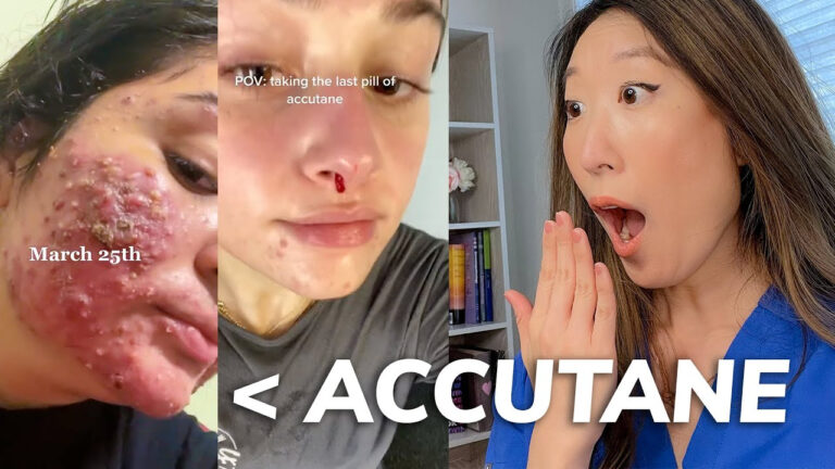 EVERYTHING You Need To Know About ACCUTANE Dermatologist Explains 
