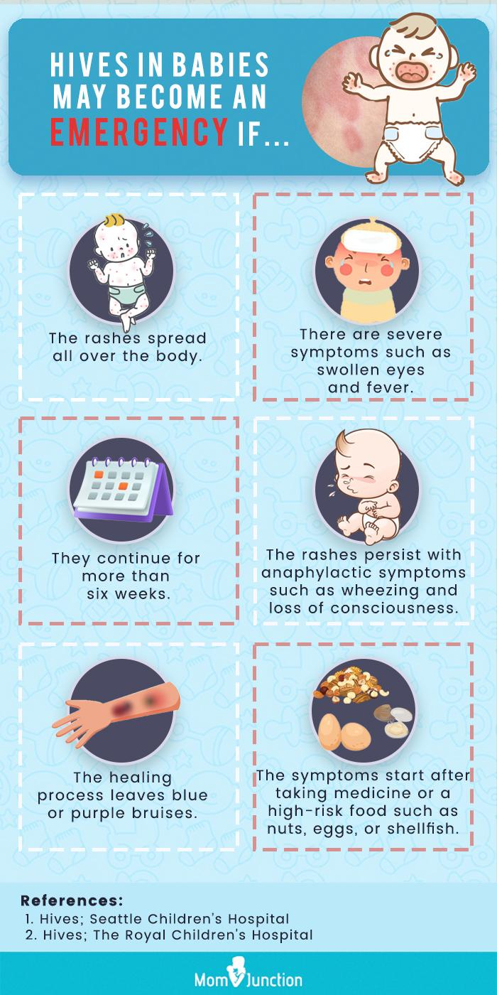 Hives On Baby Causes Symptoms Treatment And Prevention MomJunction