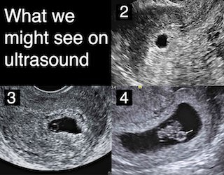 How Soon Can Baby Be Seen On Ultrasound Kiser Crautepred