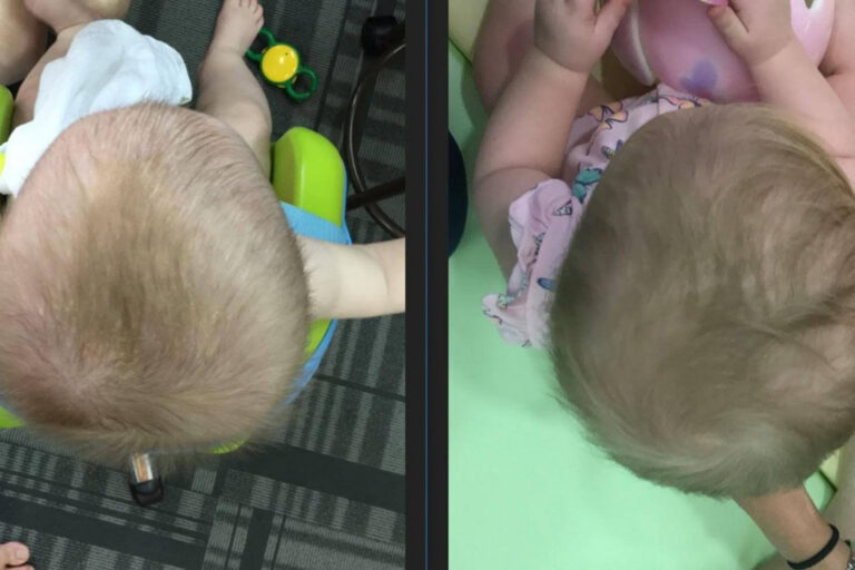 How To Fix Baby 39 s Flat Head Without Helmet