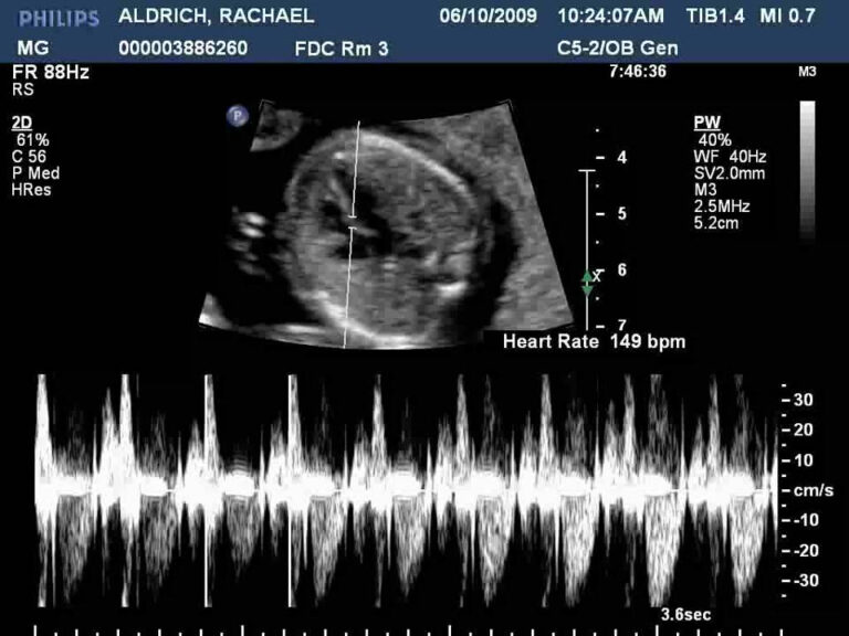 How To Know Baby Heartbeat Starts At Hazel Peterson Blog