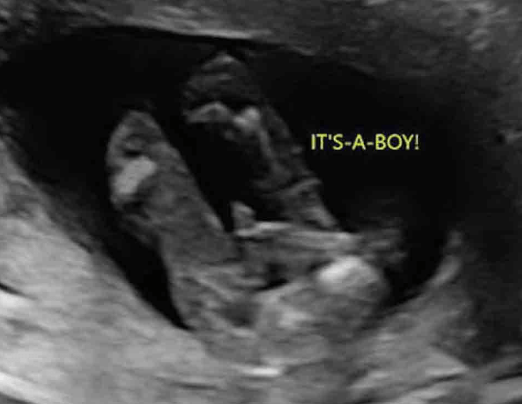 How To Tell Your Baby 39 s Gender From An Ultrasound Picture