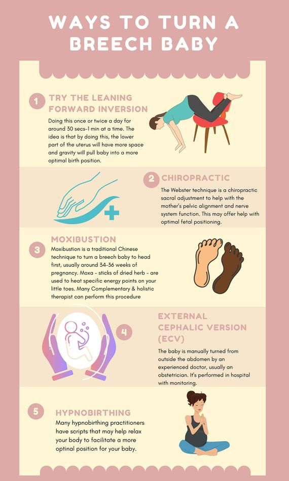 How To Turn A Breech Baby Printable Educational Poster For Birth 