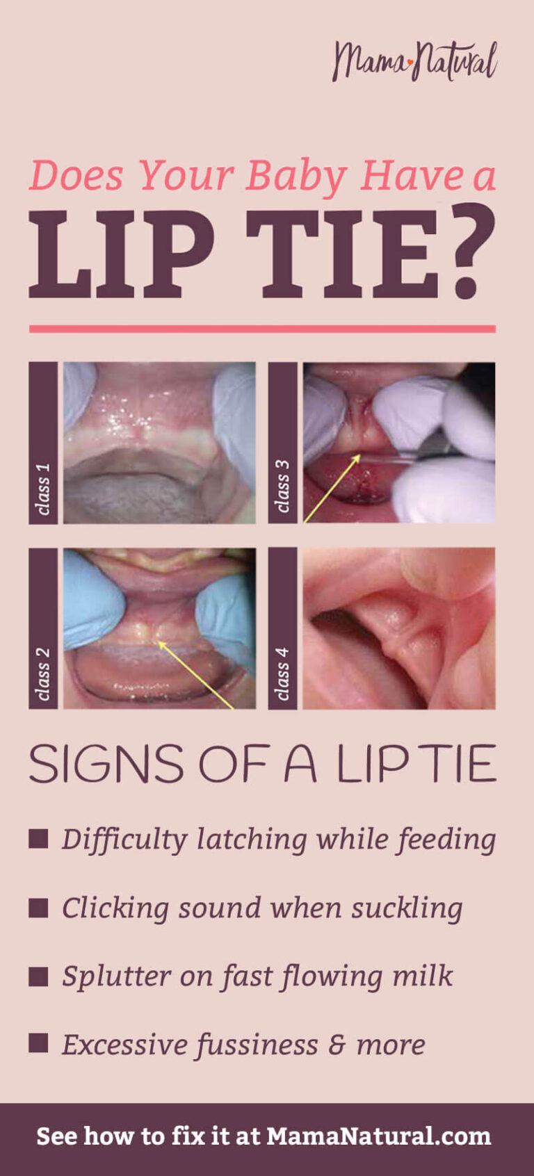 Lip Tie How To Check Your Baby And How To Fix It 