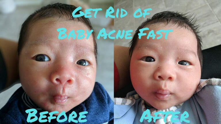 Neonatal Acne