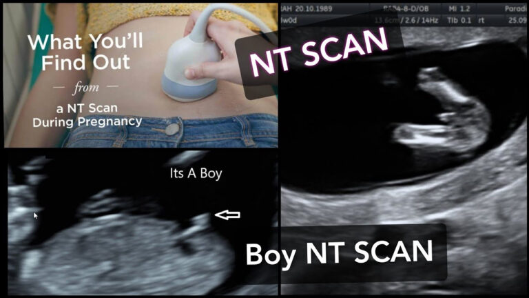 NT SCAN How To Find Baby 39 s Gender In NT SCAN NT Scan Report 