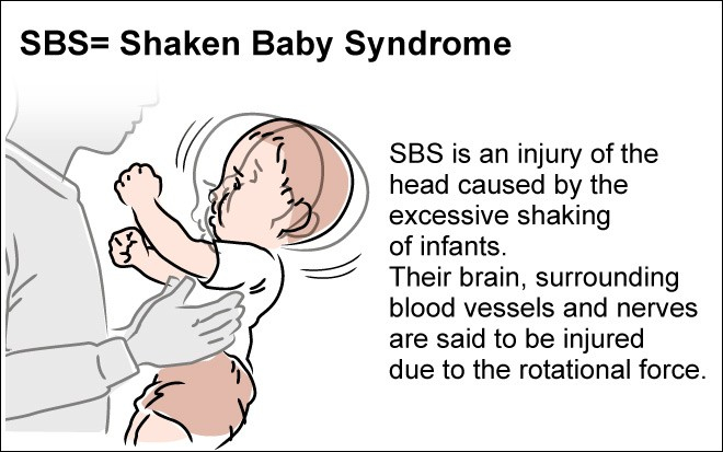 Shaken Baby Syndrome what To Know 