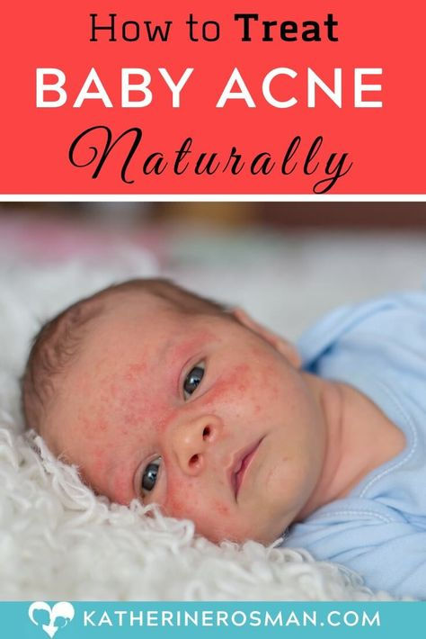 Top 10 Baby Acne Remedy How To Get Rid Of Ideas And Inspiration