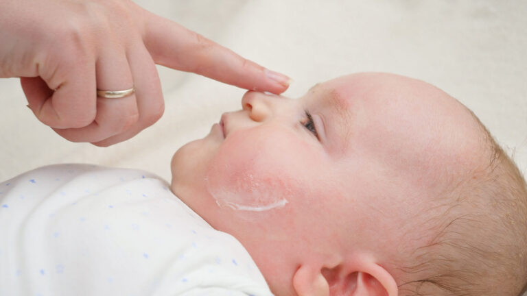 What To Put On Baby Acne Probiotics tips