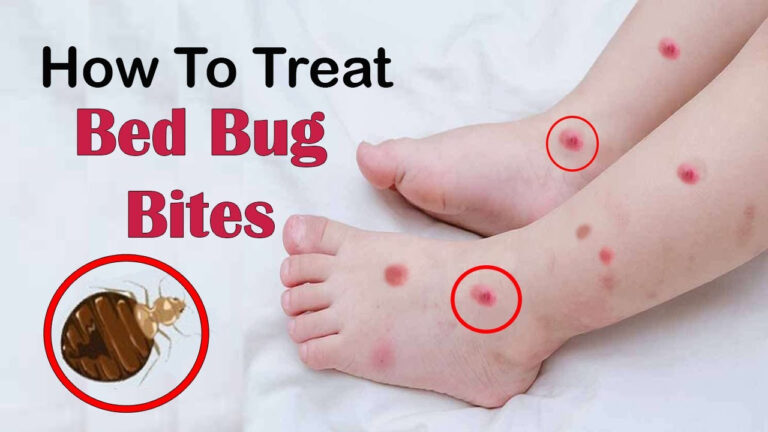What To Put On Skin Do Bed Bugs Won 39 t Bite At Sarah Alanson Blog