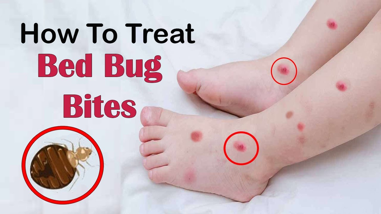What To Put On Skin Do Bed Bugs Won 39 t Bite At Sarah Alanson Blog