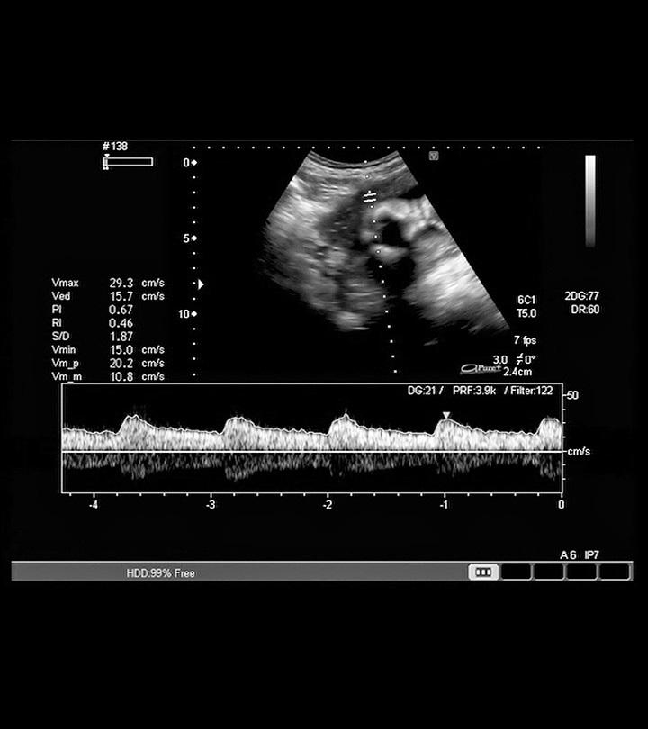 When Can You Hear Fetal Heartbeat A Week by Week Chart